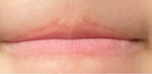 上唇が色素沈着？のようになっているんですが、すごくコンプレックスなんです。口の形は好きなんですが、治す方法はありますかね？？？