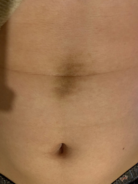 誰か助けて下さい 4年ぐらい前に急にお腹に大きいシミ が出来て本当 Yahoo 知恵袋