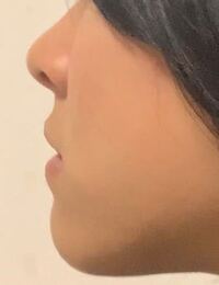 至急なぜしゃくれっぽく見えるのでしょうか 顔周り痩せたら顎もシュッとし Yahoo 知恵袋