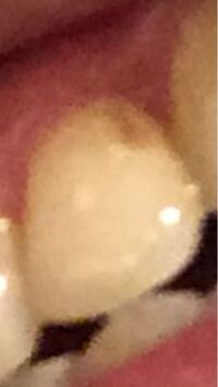 歯に茶色の部分があるんですが何ですか 矯正をしていたので恐らく歯科衛生 Yahoo 知恵袋