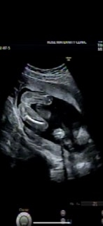 妊娠19週の妊婦です 男の子 女の子どちらに見えますか よろしくお願 Yahoo 知恵袋