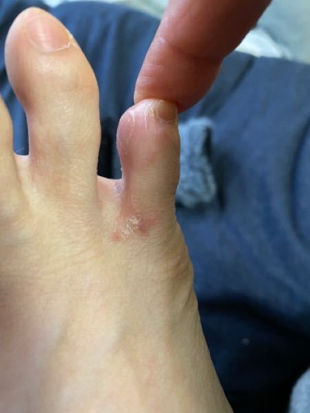 すみません 足の画像見てください 水虫ですか？ 指の股の皮膚が剥けて 最近、かゆくなりまして、湿疹みたくなってます よろしくお願いします