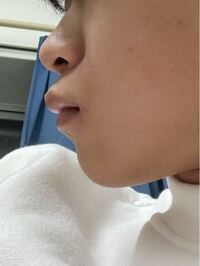 ここまで酷い口ゴボは歯列矯正だけで治ると思いますか Yahoo 知恵袋