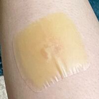 低温やけどの水脹れのところに キズパワーパッドを貼ったのです Yahoo 知恵袋