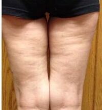 写真あり お目汚し失礼致します お尻の下の部分 太もも裏 のボ Yahoo 知恵袋