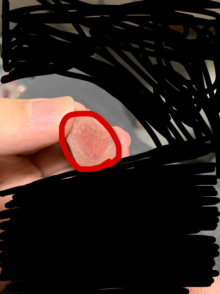 閲覧注意真正包茎です 包皮の内側に写真のようなぶつぶつができてしまい Yahoo 知恵袋