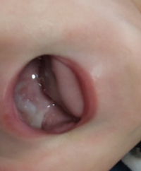 もうすぐ７ヶ月の赤ちゃんがいます 完ミで育ててて 最近上の歯の歯茎が白 Yahoo 知恵袋