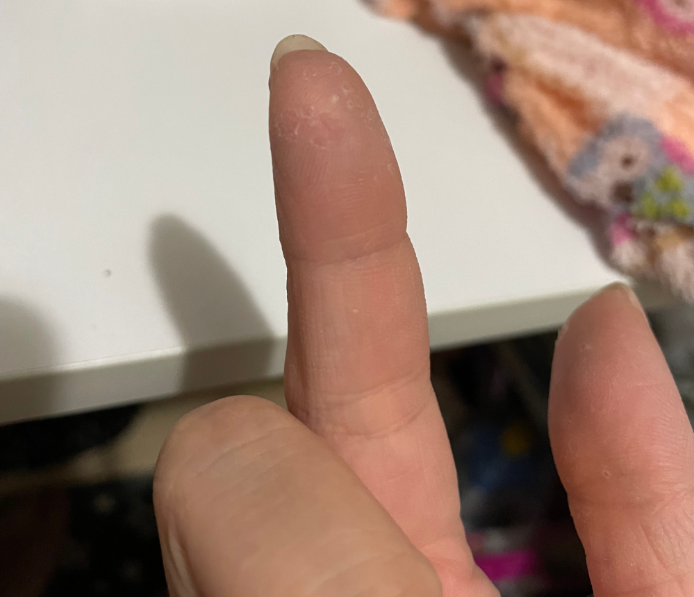 親指と人差し指のみにこのような皮膚の皮剥けがあります。これは何でしょうか？