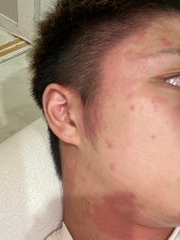 お酒を飲むと 画像のように顔がまだらに赤くなるのですが これ Yahoo 知恵袋