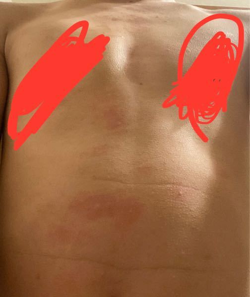 皮膚の病気 アトピー 解決済みの質問 Yahoo 知恵袋