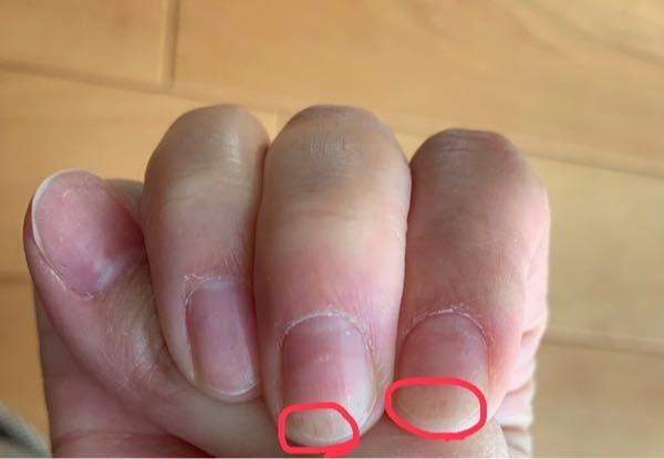 スカルプネイルで二枚爪になり痛い 3 21にスカルプネイル Yahoo 知恵袋