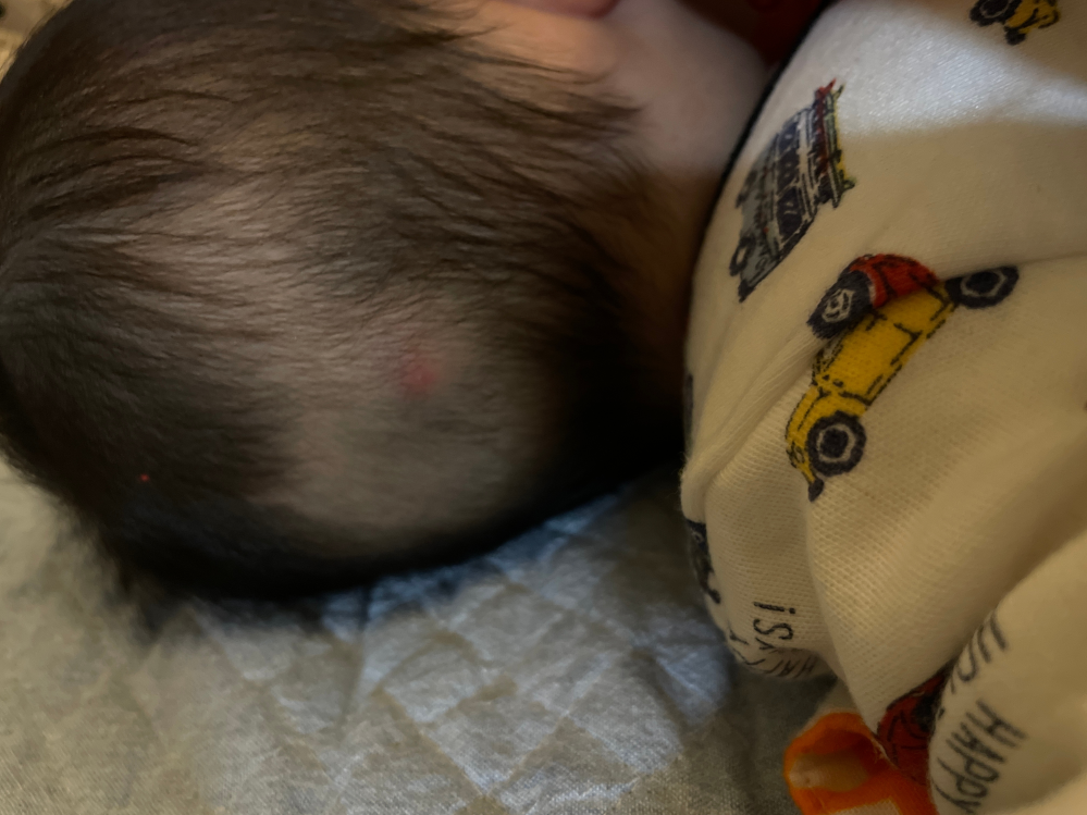 生後6ヶ月の息子の後頭部に 写真のようなぽこっと赤く脹れたできもののよ Yahoo 知恵袋