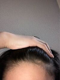 中学生です 最近前髪の辺りが痒いんですがハゲの前兆ですか 因みに前髪の Yahoo 知恵袋
