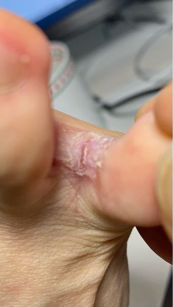 足の薬指と小指の間にまたがる水疱ができ、それを潰したのですが、今かなり痒くなっています。これって水虫なのでしょうか？