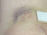 思いっきり膝を着いて出来たあざなんですけど 着いた後からアザになる前に Yahoo 知恵袋