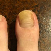 汚い足の爪の写真があります 足の親指の爪が変色 Yahoo 知恵袋