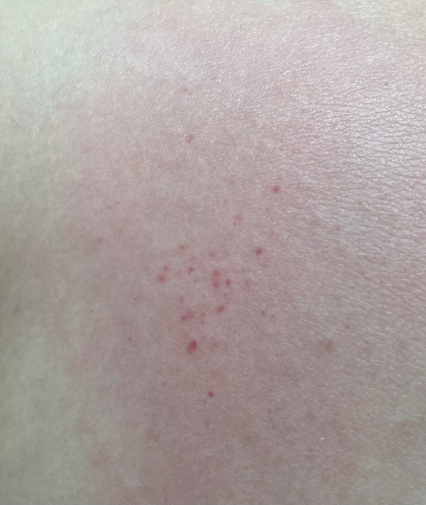 足痒くてかいたらなぞの赤い斑点が出来たんですけど…。これってなんですかね…。 たっっまぁぁぁに、なる時あるんですけど、 いつもかいたら赤い斑点が現れる訳では無いです。アレルギーですかね…？