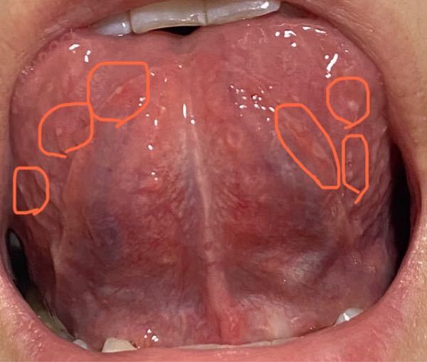 ‼️閲覧注意‼️ 舌の裏筋に口内炎。 毎月生理一週間前くらいから舌の裏に口内炎が多発します。 大きいのより小さいのがいっぱいできる感じです。 生理前でホルモンバランスが崩れてるのでしょうか？生理...