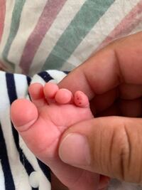 至急お願いします 生後12日の赤ちゃん 小指に内出血 っぽいものが両足 Yahoo 知恵袋