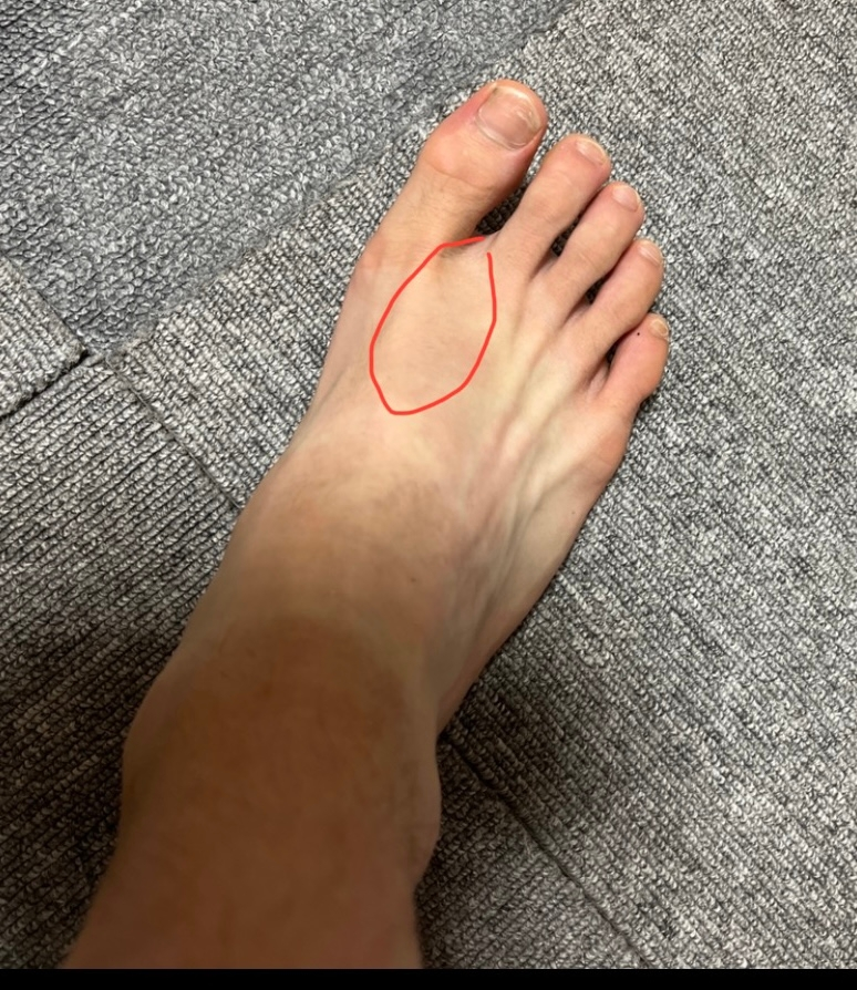 陸上部長距離をやっています画像の通り足の親指と人差し指の骨の Yahoo 知恵袋