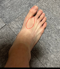 陸上部長距離をやっています画像の通り足の親指と人差し指の骨の Yahoo 知恵袋