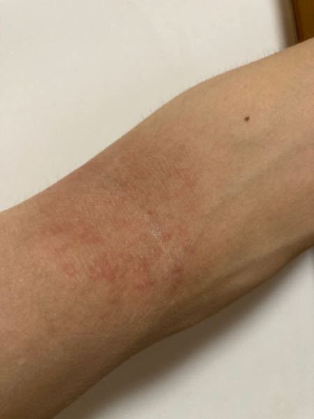 皮膚の病気 アトピー 解決済みの質問 Yahoo 知恵袋