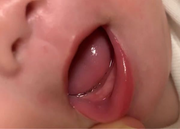 赤ちゃん、これは歯ですか？ 生後4ヶ月なのですが早産児なので修正3ヶ月ちょいくらいです。最近ヨダレが多く指をかみかみしていたので見てみるとこうなっていました。