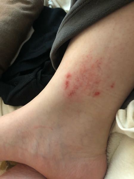 帰宅したら足がこんななってました。 ムヒソフトを塗ると、とってもヒリヒリ痛いです。かいてないのにこの様な症状。 普通の蚊に刺されではないですよね？ どんな虫にさされるとこんななるのか虫に詳しい...