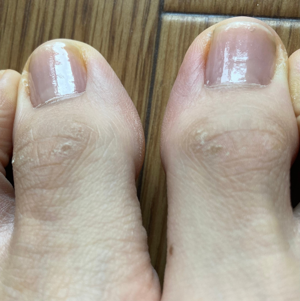 足の親指について悩んでいます。 第一関節のところがかたく黒ずんで、たまに痒くなります。 1年前に皮膚科に行き、亜鉛華軟膏「ホエイ」5gとマイザー軟膏5gの混合薬を処方していただきましたが良くなり...