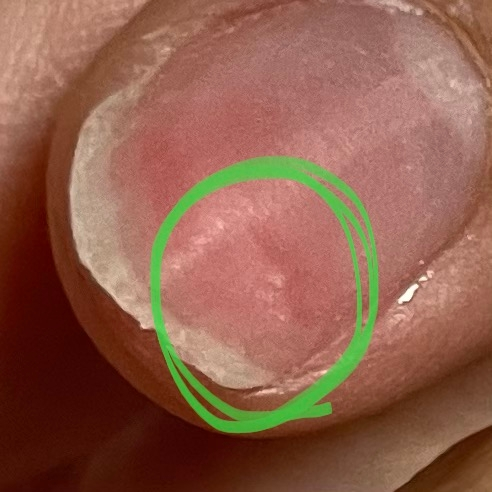 爪の一部が凹んでいてまあまあ痛いです。 （写真の爪先端ガタガタでごめんなさい。） 自分では削りすぎかな？と思っていますが他に原因はありますか？ あとどうすれば治りますか？