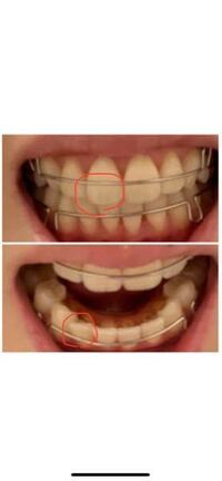 矯正失敗した気がします 下の歯4番が斜めに入りました上 Yahoo 知恵袋