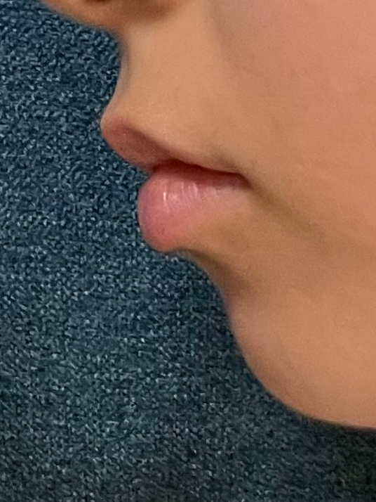 矯正を終えましたが まだ口元が気になります もう整形しかないですかね Yahoo 知恵袋