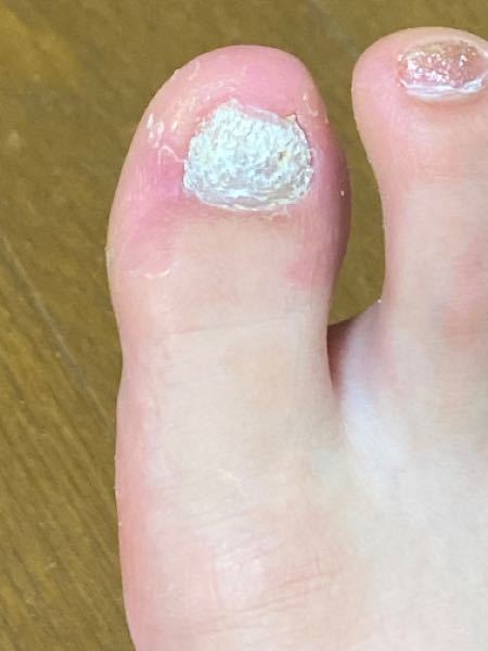 足の指なのですが病院では爪水虫と診断され3年前くらいまで爪に直接塗布する薬を塗ってました。2年後に完治したと思い塗布するのをやめたら半年後くらいにまた元に戻りました。 これは少し伸びてきた爪の表...