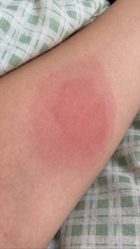 6月18日お昼の1時頃に虫刺されに気づきました 少し赤くな Yahoo 知恵袋