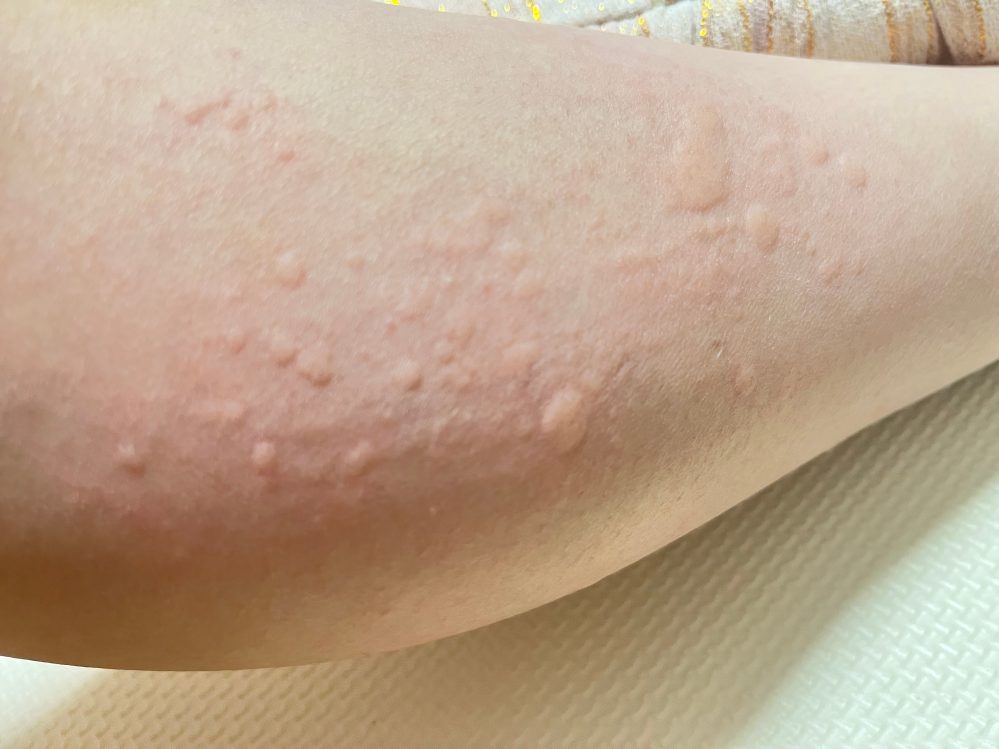 朝起きたら明日に発疹？痒みが強いのですが、ダニなどの可能性はありますか？ 写真添付しておきます。 当方アレルギー体質の為アレルギーの発疹の可能性もあるかどうかわかる方いらっしゃいますでしょうか？ 