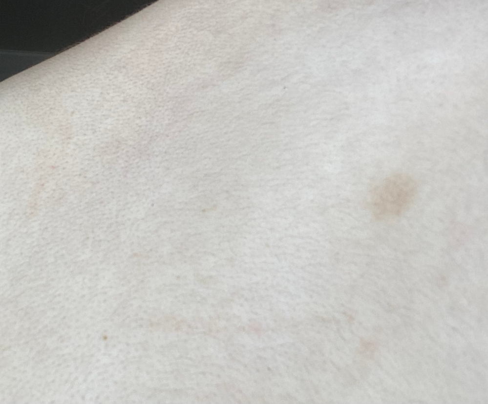 金属アレルギーのパッチテストを7ヶ月前に行い ニッケル部分の丸い跡が色素沈着していまだに背中に残っています。 これはなおるのでしょうか？皮膚科に連絡してもいいのでしょうか？ 茶色の丸です