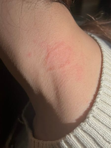 蕁麻疹の跡でこれは有り得ますか？？、、 噛まれたみたいになってます。。