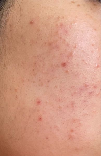 ニキビケア 解決済みの質問 Yahoo 知恵袋