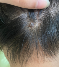 うなじの上の辺りに何かできたんですけどなんでしょうか ニキビ Yahoo 知恵袋