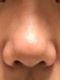 この団子鼻を治したいです どうしたら綺麗な鼻になり Yahoo 知恵袋