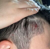 先日髪の毛を刈り上げました そしたら後頭部がニキビだらけ Yahoo 知恵袋