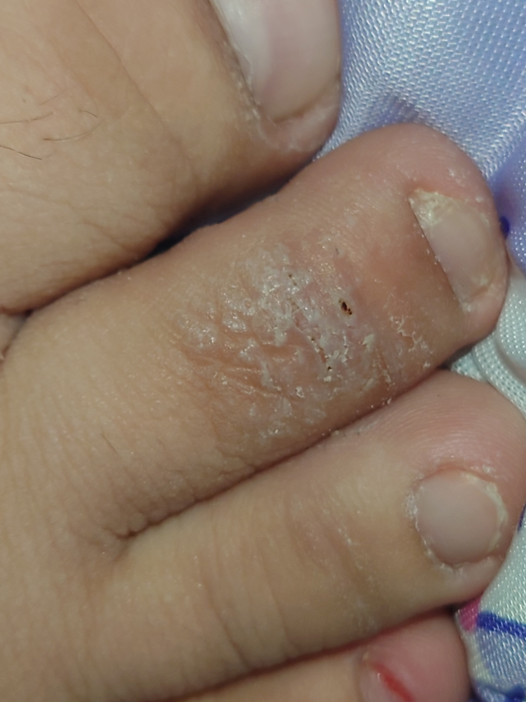 足の指の人差し指があれている原因は、なんだと思いますか？ 触るとザラザラして、皮もめくれます。 昔から、人差し指の皮膚だけ他の指に比べ、茶色いです。それもなぜか教えてください。