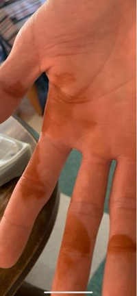 朝 起きたら 手のひらがこんな事にこれって 病気ですか Yahoo 知恵袋