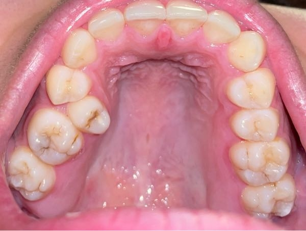 閲覧注意 これって虫歯でしょうか？ 私は生まれて22年 歯医者に行ったことがありません。なぜなら学生まで学校の検診で虫歯と診断されたことがないからです。 大人になってから、自分は本当に虫歯がな...