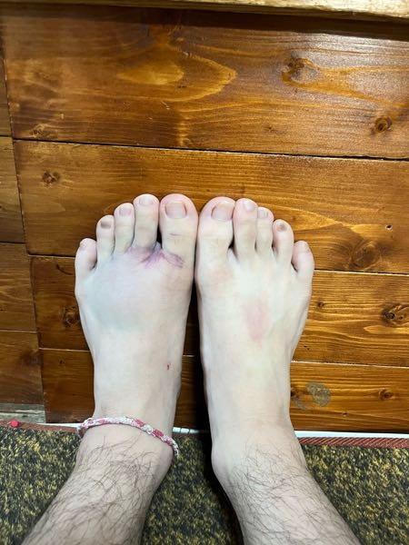 質問です。 昨日運動施設的なところで遊んでいた時にロープを渡ろうとした際に足を滑らせて爪先から転倒してしまいました。その時からずっと左足の親指と人差し指が痛みます。これは折れてますか？