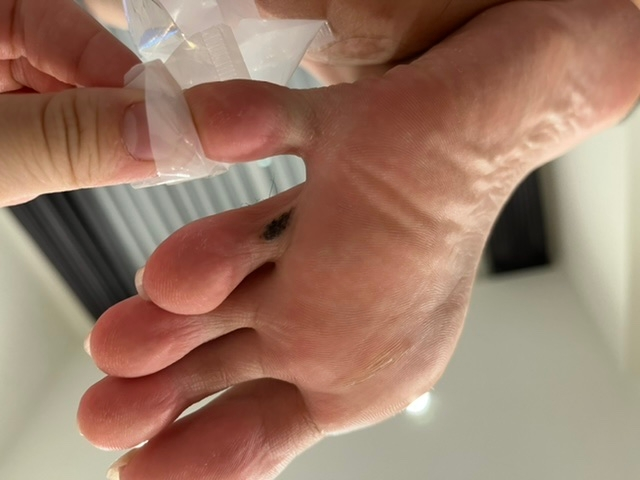 足の写真あります。旦那の足の指に黒いシミ、斑点ができてました。これは癌でしょうか？できてる方、わかる方いらっしゃるでしょうか？メラノーマですかね？