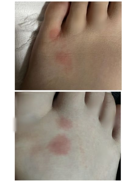 上が左足、下が右足です。 足だけにこのようなものがあります。 蚊に刺されただけでしょうか？ 昨日からかゆみはあり、痛みはないです。