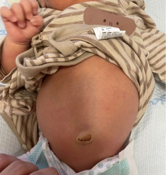 生後24日目の新生児のお腹なのですが こちら過飲症候群でしょ Yahoo 知恵袋