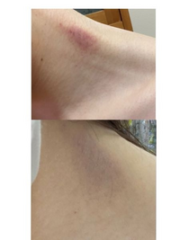 至急お願いします 首につけられたキスマークの隠す方法を教えて Yahoo 知恵袋