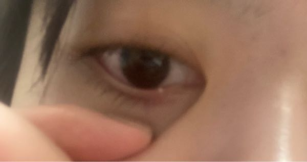 目の病気 すべての質問 Yahoo 知恵袋